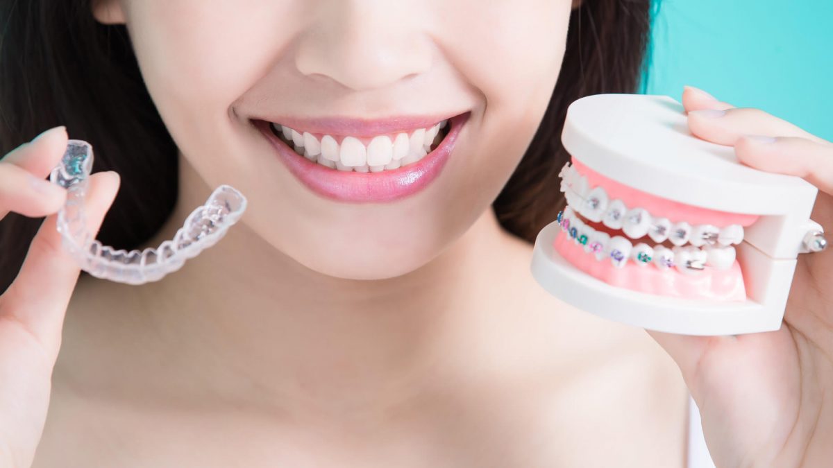 Everything You Should Know About Braces