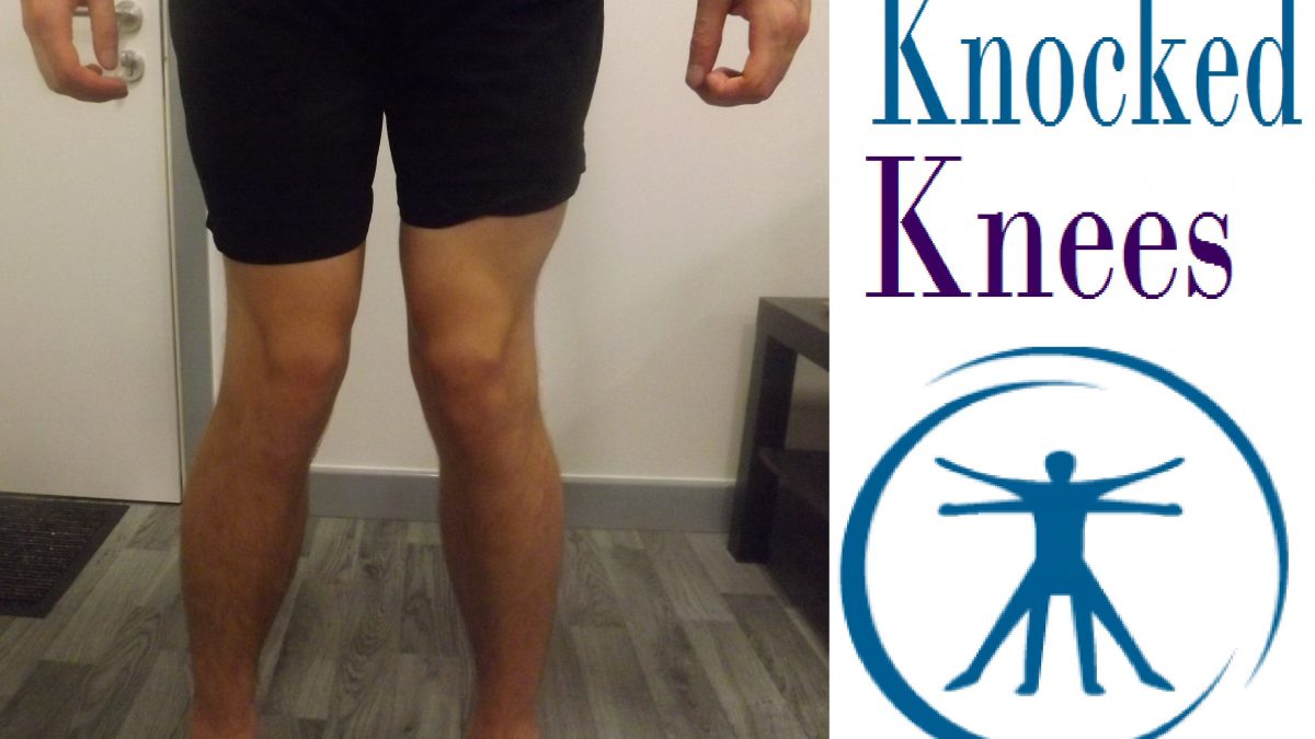 How Long Does It Take To Treat Knock Knees With The Help Of Exercises?